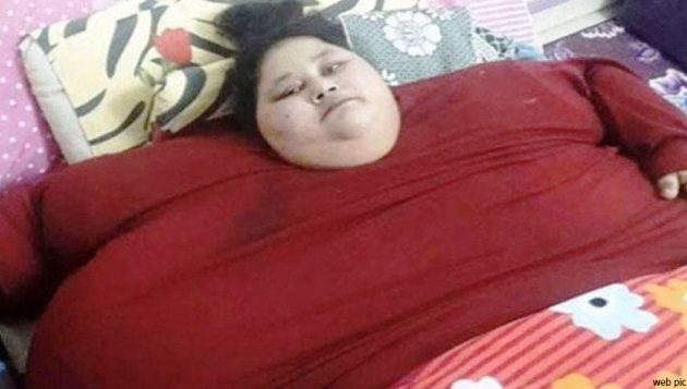 विश्वकै सबैभन्दा बढी तौल भएकी महिलाको शल्यक्रिया भारतमा